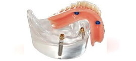 Denture Implants Perth, WA Karratha, Port Hedland